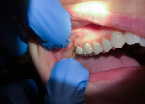 Best Knocked-Out Tooth (Avulsed Tooth) Treatment in Erin, TN